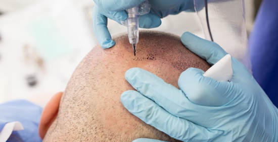 que es micropigmentación capilar